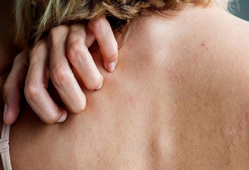 Ngứa do suy thận không đơn thuần là bệnh ngoài da mà là biểu hiện của tình trạng “nhiễm độc” từ bên trong cơ thể.