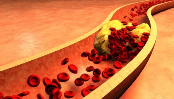 high-cholesterol-1788600766.webp