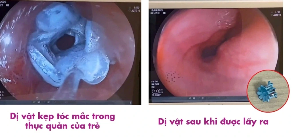 be-gai-5-tuoi-nhap-vien-cap-cuu-vi-nuot-phai-kep-toc-2-edited-1758276471024-1758340827.webp