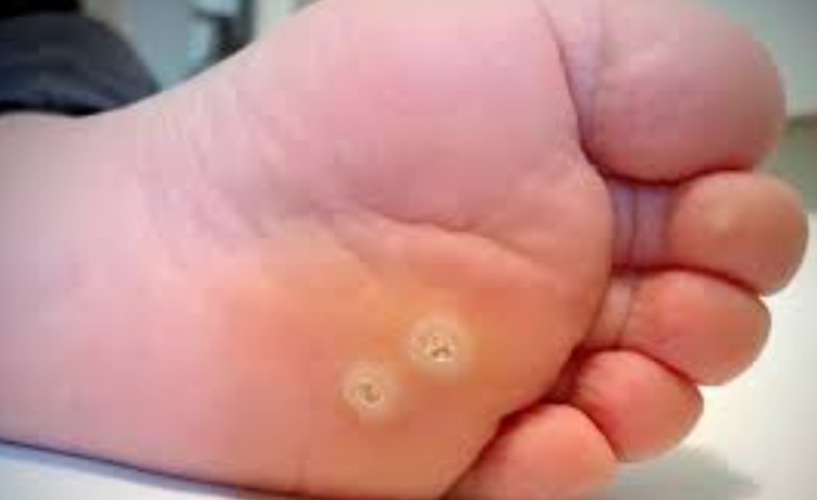 hpv-2-1786524190.jpg