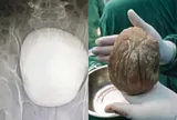Chủ quan với triệu chứng tiểu bất thường, người đàn ông bàng hoàng phát hiện viên sỏi bàng quang khổng lồ nặng 1,3kg