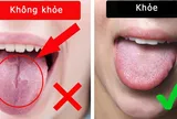 3 dấu hiệu trên lưỡi có thể cảnh báo gan đang gặp vấn đề nghiêm trọng
