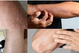 Ngứa kéo dài ở đâu và đi kèm dấu hiệu gì thì nên đi khám?