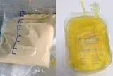 Ăn đồ chiên, uống trà sữa suốt một năm, cô gái 27 tuổi nhập viện khẩn cấp, bác sĩ lắc đầu