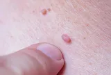 Trẻ 10 tuổi đi bơi về, lòng bàn chân mọc đầy nốt nhỏ: Phát hiện nhiễm HPV, cảnh báo sai lầm nhiều phụ huynh mắc phải
