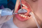 Lấy cao răng tưởng đơn giản, nhưng có trường hợp được BHYT chi trả: Ai thuộc diện này?