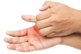 Ngứa lòng bàn tay, bàn chân kéo dài: Cẩn thận dấu hiệu liên quan đến bệnh gan