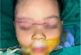 Bé gái 22 tháng tuổi bị chó cắn tổn thương nặng, hiện ra sao?