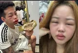 Mặt sưng vù, mắt híp tịt sau khi "đu trend" ăn bánh trứng kiến: Bác sĩ cảnh báo điều này