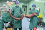 Người đàn ông có chiếc bụng phình to như mang thai nhiều tháng, bác sĩ lấy ra thứ "đáng sợ" bên trong khiến nhiều người rùng mình