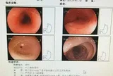 Ăn lẩu quá nóng rồi uống nước đá cho dịu, người phụ nữ không ngờ thực quản đã bị loét nghiêm trọng