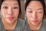 Tin lời “giám đốc thẩm mỹ”, cô gái sống 6 năm không thể nhắm mắt sau ca cắt mí hỏng