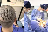 Da đầu chàng trai 23 tuổi bỗng nhiên dày lên, gấp nếp như... bộ não: Đi nhiều bệnh viện vẫn bị từ chối chỉ vì một lý do