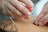 Đau chân dữ dội chỉ sau buổi châm cứu đầu tiên, người phụ nữ đi chụp X-quang rồi phát hiện sự thật khó tin