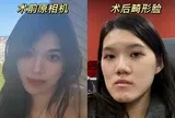 Từ móm nhẹ thành mặt "lưỡi cày" sau ca phẫu thuật thẩm mỹ, cô gái "khóc thét" trước lời giải thích của bác sĩ