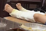 Lén bắt chước siêu nhân nhảy từ trên cao xuống, bé trai gãy cả hai xương gót chân