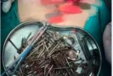 Đau bụng, nôn mửa liên tục, người đàn ông đi khám rồi tá hỏa khi thấy 180 "vật thể lạ" nhọn hoắt trong dạ dày: Bác sĩ cảnh báo điều này