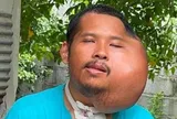 Người đàn ông có khuôn mặt biến dạng đến khó tin chỉ vì một thói quen mà nhiều người vẫn làm mỗi ngày