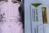 Bé gái 5 tuổi nuốt thỏi vàng dài 4 cm, bác sĩ phải kích hoạt "kênh xanh" khẩn cấp
