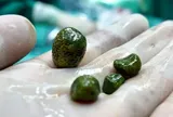 Tưởng bốn vật thể màu xanh là những viên đá quý, sự thật bên trong cơ thể cô gái lại khiến nhiều người “nổi da gà”