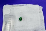 Bé trai suýt hỏng tai vì tự lấy dị vật bên trong theo cách này