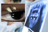 Phát hiện "vật thể lạ" đáng sợ mọc trong hốc mắt thiếu nữ 16 tuổi, bác sĩ bàng hoàng khi gắp ra thứ này