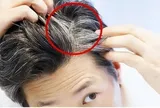 Tóc trắng mọc trên trán, thái dương và sau đầu cảnh báo điều gì? 7 việc cần làm để tóc luôn đen nhánh