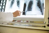 Virus Hanta là gì? Virus Hanta có thuộc danh mục bệnh nghề nghiệp không?