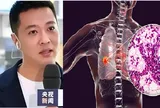 Nam MC điển trai qua đời chỉ sau 15 ngày phát hiện ung thư: Bác sĩ cảnh báo "đừng xem nhẹ cơn ho kéo dài"