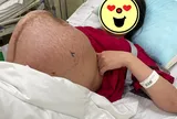 Chiếc bụng mang thai đôi chằng chịt vết rạn, ai nhìn cũng xót xa: “thở thôi cũng mệt”