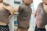 6 cuộc đại phẫu cứu bé trai mang "mai rùa" trên lưng suốt 7 năm