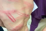 Vụ bé trai 8 tuổi nhập viện với nhiều vết bầm tím: Người cha trình diện, khai lý do đánh con