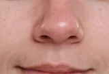 Mụn đầu đen tái đi tái lại dù chăm da kỹ? Nguyên nhân có thể nằm ở những thói quen hằng ngày của bạn