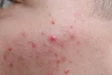 Sai lầm khiến trứng cá đỏ tái phát liên tục và 5 bước chăm sóc da dịu nhẹ