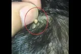 Bà nội vô tình thấy vật thể lạ bằng hạt gạo dính chặt trên đầu cháu gái, đưa đi khám bác sĩ thở phào