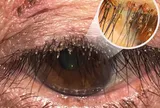 Ngứa, cộm mắt kéo dài, người phụ nữ đi khám mới biết rận mu bám chi chít trên lông mi