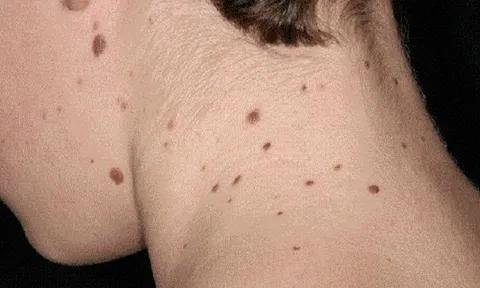 Khi nào cần cắt bỏ nốt ruồi?