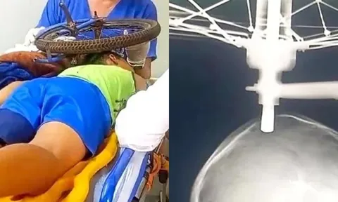 Bé trai 9 tuổi bị bu-lông xe đạp cắm xuyên sọ sống sót kỳ diệu