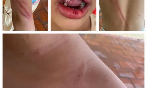 Vụ bé gái 10 tuổi bị cha dượng đánh đập ở Bình Dương: Có thể khởi tố vụ án trong trường hợp nào?