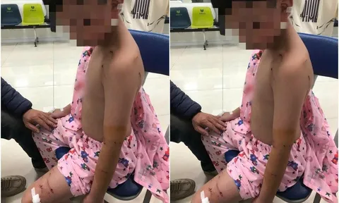 Thương tâm: Đi chúc Tết, bé trai bị chó tấn công phải khâu nhiều mũi