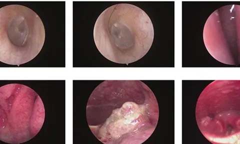 Sụt 5kg trong 1 tháng, người đàn ông 47 tuổi mắc cùng lúc 2 bệnh ung thư: Thủ phạm từ thói quen uống 300ml loại đồ uống này mỗi ngày