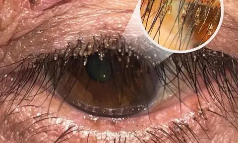 Đi khám vì ngứa mắt, phát hiện "thứ kinh hoàng" bám chi chít trên lông mi 