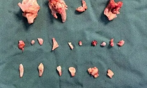 Cô gái trẻ đau bụng dưới dữ dội, kiểm tra phát hiện "thứ quái dị" bên trong