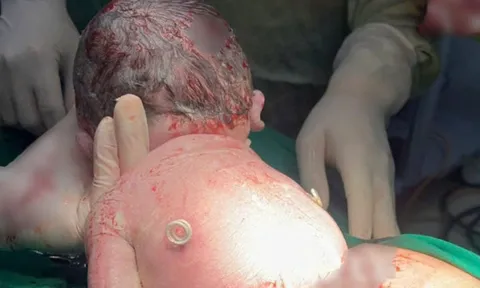 Bé sơ sinh chào đời mang “đôi cánh lạ” trên lưng