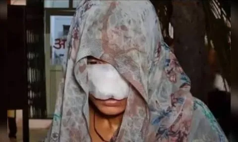 Cãi nhau, chồng cắn vào mũi và má khiến vợ phải khâu 10 mũi: Ám gương mặt biến dạng của nạn nhân