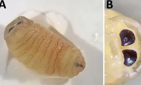 Người phụ nữ kinh hãi phát hiện sinh vật lạ đang "ăn" dần vách ngăn mặt sau 2 tuần đau đớn