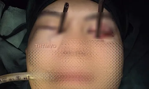 Rùng mình ca tai nạn hiếm gặp, thanh niên bị đũa xuyên cả hai mắt: 1mm may mắn đã giúp giữ lại ánh sáng cho nạn nhân như thế nào?