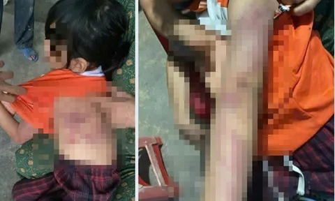 Bé gái lớp 2 ở Hà Tĩnh bị bạn đánh bầm tím da: Đại diện trường học thừa nhận thiếu sót, hé lộ nguyên nhân
