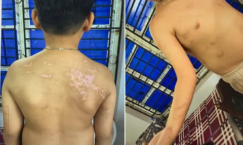 Khởi tố người cha đánh con ruột thương tích 36%: Bàng hoàng công cụ gây án
