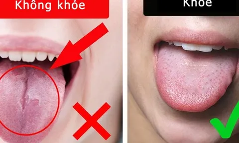 3 dấu hiệu trên lưỡi có thể cảnh báo gan đang gặp vấn đề nghiêm trọng